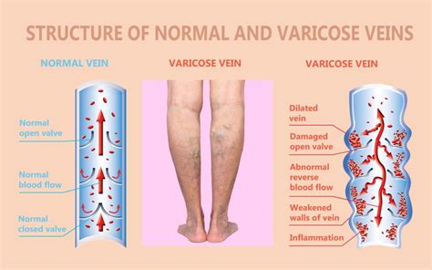 What Causes Vein Disorders? - Vein Specialists of the Carolinas