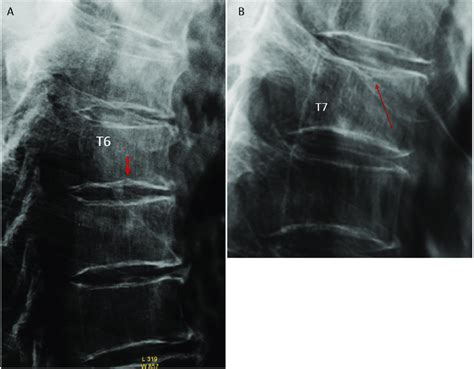 (A) T6 lower endplate fracture with broken endplate line and slight ...