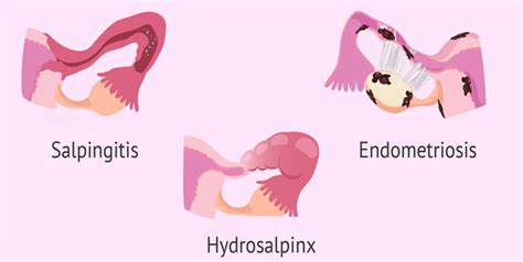 Expert Explains About Fallopian Tube Blockage And Its Impact On Fertility