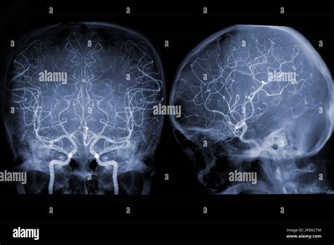 Imagen De Angiograf A Cerebral De La Fluoroscopia En Radiolog A De