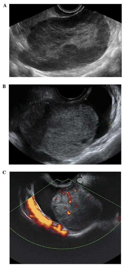 The Characteristic Ultrasound Features Of Specific Types Of Ovarian