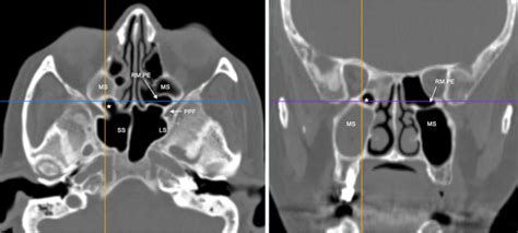 Retromaxillary Pneumatization Of Posterior Ethmoid Air 50 Off