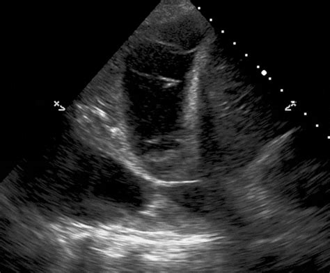 Lung Ultrasound Made Easy Step By Step Guide Pocus Academy