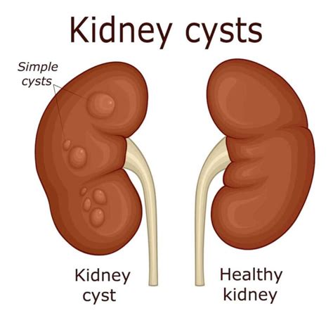 Kidney Cyst Symptoms: What You Need to Know About Kidney Cyst Signs and Symptoms - Page 7 of 7 ...