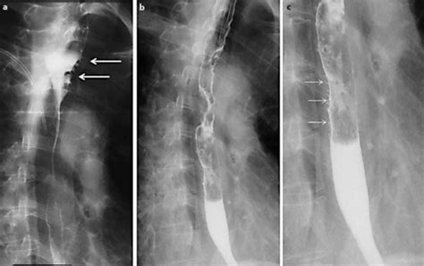 Radiography of the esophagus before and after treatment. a Before any ...