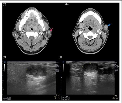 Figure 1 From A Case Of Initially Metastasizing Pleomorphic Adenoma Of Parotid Gland Semantic