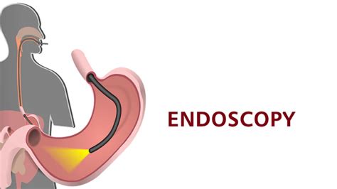 Endoscopy Procedure Colonoscopy Step by step Recovery Coimbatore