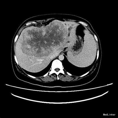 肝脏影像系列一肝内胆管细胞癌 医联