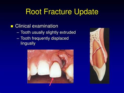 PPT Traumatic Injuries To The Teeth PowerPoint Presentation ID 1214569