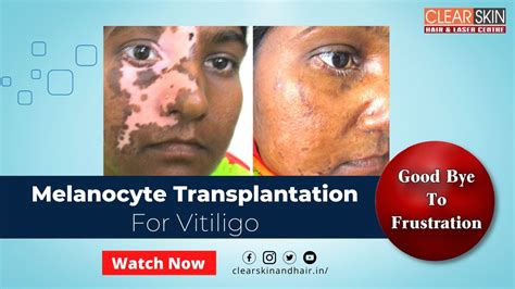 Melanocyte Transplantation Surgery For Vitiligo Advance Vitiligo Treatment Dr Kailash