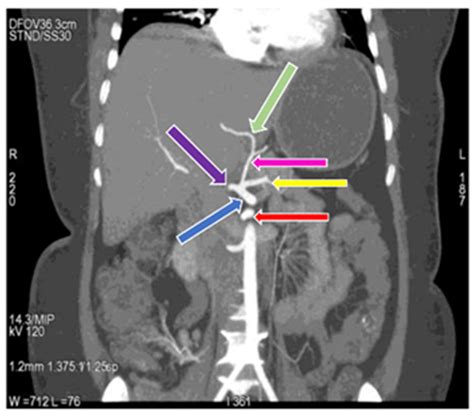 Angiogram Celiac Axis