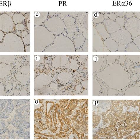 Immunohistochemical Staining For Er Er Pr Er Egfr And Her