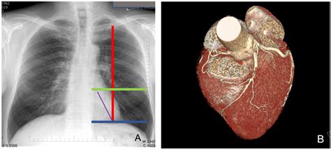 Jcm Free Full Text Robotic Assisted Minimally Invasive Direct