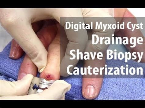 Drainage Shave Biopsy Cauterization Digital Myxoid Cyst Dr Derm