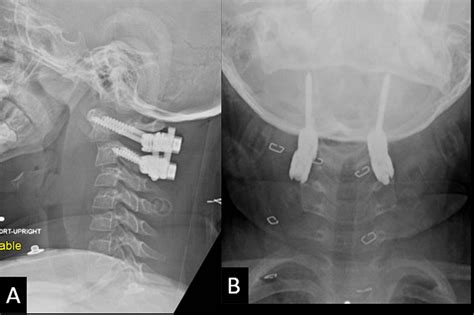 Lateral A And Anterior Posterior B Upright Cervical Spine Plain