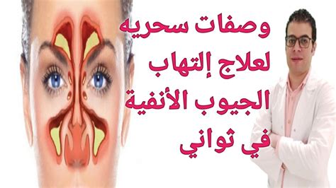 أسرع علاج إلتهاب الجيوب الأنفية علاج الجيوب الانفية YouTube