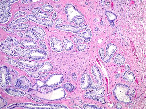 Sertoli Leydig Tumor Ovary