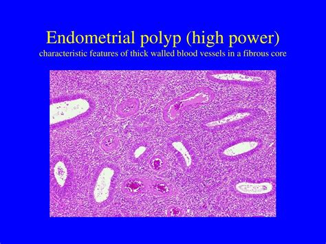 PPT - Endometrial polyps PowerPoint Presentation, free download - ID ...