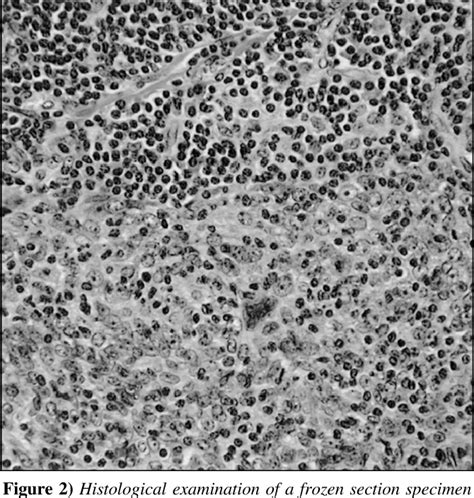 Figure 2 From Primary Lymphoepithelioma Like Carcinoma Of The Lung