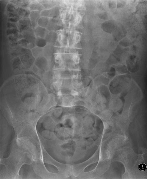 Abdominal X Ray Anatomy