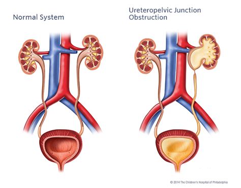 A Guide To Laparoscopic Pyeloplasty And How It Works