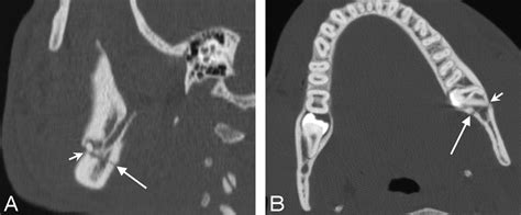 Incidence And Characterization Of Unifocal Mandible Fractures On Ct