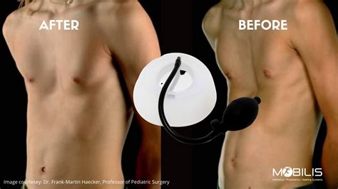 Chest Deformities Clinic Pigeon Pectus Excavatum Funnel Carinatum