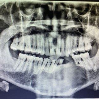 Opg Showing Well Defined Unilocular Radiolucency Extending From Apices