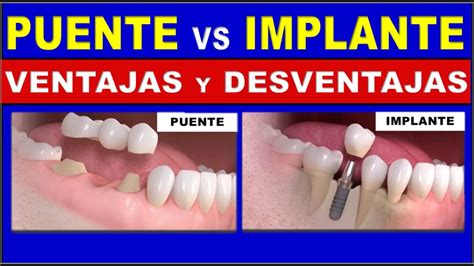 Puentes Fijos Vs Implantes Dentales Ventajas Y Desventajas Youtube