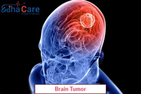 Brain Tumor Surgery Brain Tumor Removal Surgery Symptoms Causes Cost