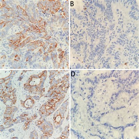 Representative Immunohistochemical Staining Of PD L1 And TLR 4 In