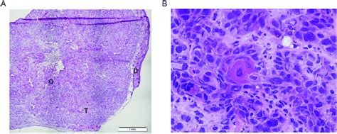 Histological Characterization Of Human A Subcutaneous Tumors In Nude