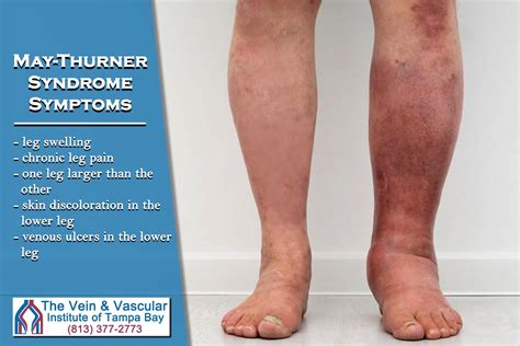 This Iliac Vein Compression In The Legs Is A Vein Disease Known As May