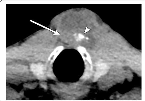 Thyroglossal Duct Cyst Mri