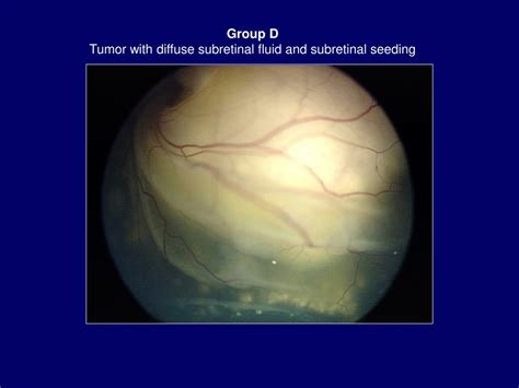 Ppt International Classification Of Retinoblastoma Powerpoint Presentation Id9357073