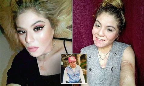 Pam Aguilar 17 From Seattle Washington Suffered Severe Burns