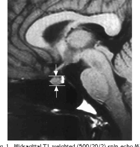 Figure 1 From Mr Height Of The Pituitary Gland As A Function Of Age And