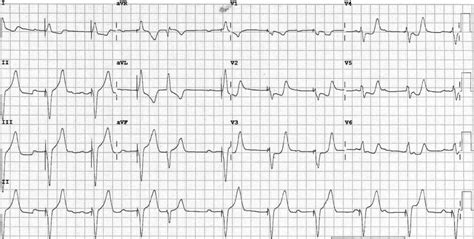 Killer Ecg Patterns Part 2 • Litfl • Ecg Library