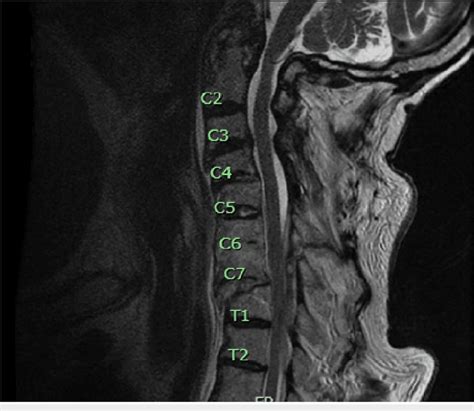 Sagittal T2-weighted MRI demonstrating an acute compression fracture of ...