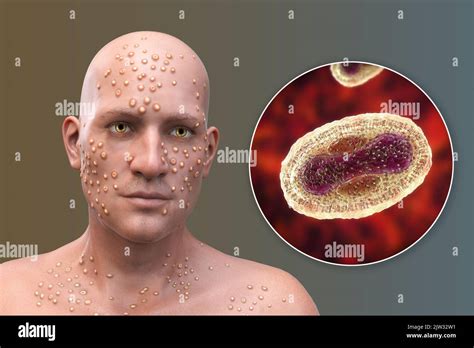 Molluscum Contagiosum Lesion Hi Res Stock Photography And Images Alamy