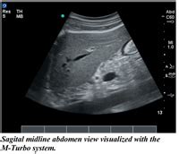 Sonosite Releases M Turbo The Micromaxx Successor Ultrasound Machine