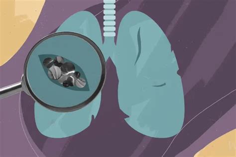 What’s the Outlook for Mycobacterium Avium Complex?