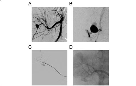 Angiographic Image Examples Of Traumatic Pseudoaneurysms Of The A Download Scientific Diagram