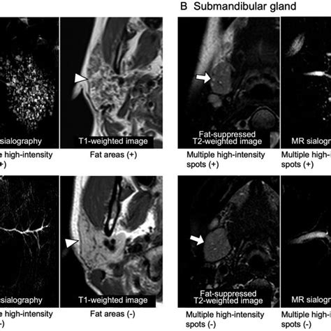 Mri Findings Of A Parotid Arrowheads And B Submandibular Arrows