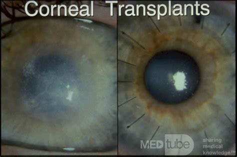 Pre And Post Corneal Transplant • Picture •