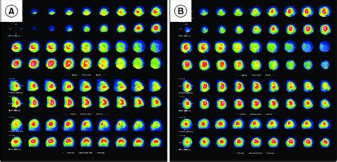 Preoperative And Postoperative Myocardial Spect A Preoperative