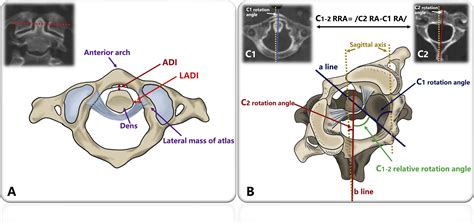 The Association Between Unilateral High Riding Vertebral Artery And