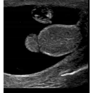 (a) Initial scrotal ultrasound showing large avascular extratesticular ...