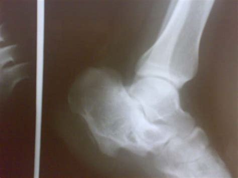 Plantar Exostosis in a Malunited Calcaneal Fracture: A rare ...