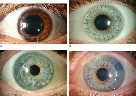 Cornea Transplant Types Success Rate Vision After Transplant